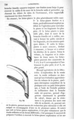 Fig. 721 - Traité de médecine opératoire, bandages et appareils. 4è éd. Tome premier
