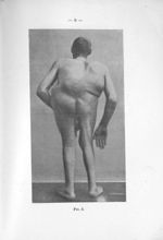 [Photographie de Jean-Pierre Mazas, présentant un curieux cas d'acromégalie associée au gigantisme]  [...]