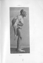 [Photographie de Jean-Pierre Mazas, présentant un curieux cas d'acromégalie associée au gigantisme]  [...]
