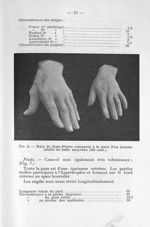 Main de Jean-Pierre comparée à la main d'un homme adulte de taille moyenne (165 cent) - Gigantisme e [...]