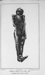 Cadavre inhumé le 27 mai 1827 et exhumé le 21 janvier 1828 - Traité de médecine légale, suivi du tra [...]
