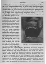 Fig. 58. Hutchinsonsche Zähne - Psychiatrie : ein Lehrbuch für Studierende und Ärzte / Vol. II