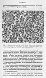 Fig. 9 - Région lombaire, partie centrale (stade ultime de la destruction) - La poliomyélite épidémi [...]