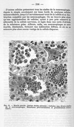 Fig. 10 - Moelle sacrée. Lésions moins avancées : cellules au divers stade de la neuronophagie. Manc [...]