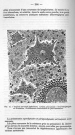 Fig.11 - Région cervicale inférieure. Lésions plus jeunes : Neuronophagies en évolution. Proliférati [...]