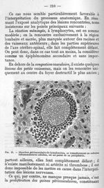 Fig. 13 - Manchon périvasculaire de lymphocites, se transformant en cellules inflammatoires adultes, [...]