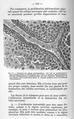 Fig. 14 - Evolution des gaines périvasculaires - La poliomyélite épidémique (maladie de Heine-Médin) [...]