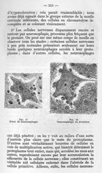 Fig. 17 Début de neuronophagie / Fig. 18 Neuronophagie en évolution - La poliomyélite épidémique (ma [...]