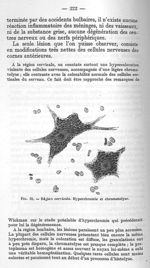 Fig. 22 - Région cervicale. Hyperchromie et chromatolyse - La poliomyélite épidémique (maladie de He [...]