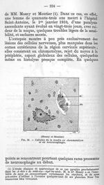 (Mosny et Moutier) Fig. 24 - cellules de la moelle en chromatolyse et en neuronophagie - La poliomyé [...]