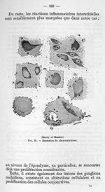(Mosny et Moutier) Fig. 25 - Exemples de chromatolyses - La poliomyélite épidémique (maladie de Hein [...]