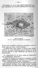 (Mosny et Moutier) Fig. 26 - Réaction inflammatoire de l'épendyme - La poliomyélite épidémique (mala [...]