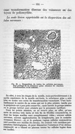 Fig. 28 - Disparition de toutes les cellules nerveuses. Etat grillagé de la substance grise. Absence [...]