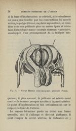 Fig. 8 - Corps fibreux sous-muqueux pédiculé (Pozzi) - Tumeurs fibreuses de l'utérus