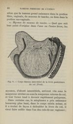 Fig. 9 - Corps fibreux interstitiel de la lèvre postérieure du col (Pozzi) - Tumeurs fibreuses de l' [...]