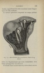 Fig. 13 - Morcellement des corps fibreux, d'après Péan (Pozzi) - Tumeurs fibreuses de l'utérus
