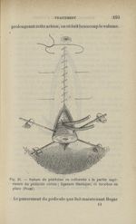 Fig. 25 - Suture du péritoine en collerette à la partie supérieure du pédicule utérin; ligature élas [...]