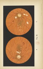 Fig. 22. a et b. Altérations du fond de l'oeil dans le diabète - Atlas manuel d'ophtalmoscopie