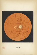 Fig. 23. Altérations du fond de l'oeil dans l'anémie pernicieuse - Atlas manuel d'ophtalmoscopie