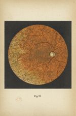 Fig. 31. Syphilis congénitale. Troubles du fond de l'oeil - Atlas manuel d'ophtalmoscopie