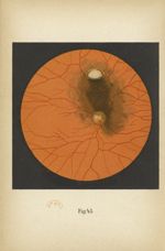 Fig. 45. Empreinte d'un corps étranger au fond de l'oeil (image droite) - Atlas manuel d'ophtalmosco [...]
