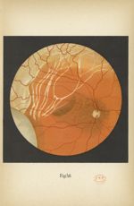 Fig. 46. Tractus cicatriciels et décollement rétinien consécutifs à une blessure de l'oeil par instr [...]