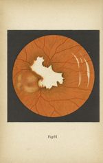 Fig. 61. Traumatisme de l'oeil. Rupture de la choroïde - Atlas manuel d'ophtalmoscopie
