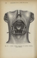 Fig. 147. Section médiane temporaire du maxillaire inférieur, d'après Sédillot - Atlas manuel de chi [...]