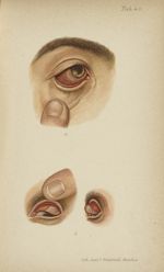 Tab. 43 a. Iritis condylomateuse / Tab. 43 b. Tarsite gommeuse de l'œil gauche. - Trachome - Atlas-m [...]