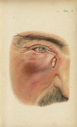 Planche II. Dacryocystite avec issue du pus à travers la peau - Atlas manuel des maladies externes d [...]