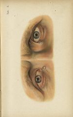 Planche III. Fistule lacrymale à droite, ectasie du sac lacrymal à gauche, épicanthus des deux côtés [...]