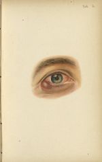 Planche V. Orgelet meibomien ou interne - Atlas manuel des maladies externes de l'oeil