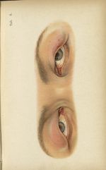 Planche VIII. Blépharochalasis - Atlas manuel des maladies externes de l'oeil