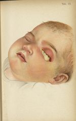 Planche XII. Ophtalmie purulente chez un nouveau-né - Atlas manuel des maladies externes de l'oeil