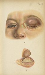 Planche XIII. a. Diphtérie conjonctivale chez un petit garçon […] - Atlas manuel des maladies extern [...]