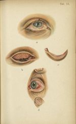 Planche XV. Conjonctivite printanière - Atlas manuel des maladies externes de l'oeil