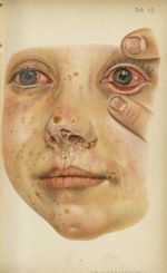 Planche XVII. Eczéma conjonctival avec eczéma abondant sur le visage - Atlas manuel des maladies ext [...]