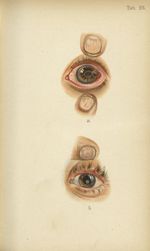 Planche XXIII. a. Perforation cornéenne et enclavement de l'iris à la suite d'une pustule suppurée d [...]