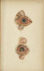Planche XXV. a. Herpès cornéen fébrile / b. Kératite à hypopion - Atlas manuel des maladies externes [...]