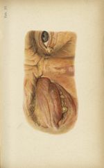 Planche XXVII. Suppuration cornéenne due à un ulcère serpigineux. Panophtalmie - Atlas manuel des ma [...]