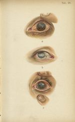 Planche XXVIII. a. Pannus trachomateux de la cornée / b. Phtisie antérieure du globe, dégénérescence [...]