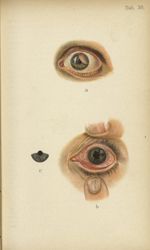 Planche XXX. a. Sarcome de l'iris / b. Iritis syphilitique - Atlas manuel des maladies externes de l [...]