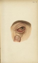 Planche XXXI. Iritis syphilitique à condylome - Atlas manuel des maladies externes de l'oeil