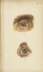 Planche XXXII. a. Cataracte sénile mûre / b. Cataracte traumatique - Atlas manuel des maladies exter [...]