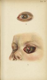 Planche XXXVIII. Gliome double de la rétine - Atlas manuel des maladies externes de l'oeil