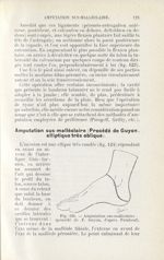 Fig. 124. Amputation sus-malléolaire (procédé de F. Guyon, d'après Farabeuf) - Atlas-manuel de chiru [...]