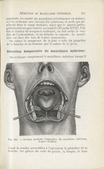 Fig. 228. Section médiane temporaire du maxillaire inférieur, d'après Sédillot - Atlas-manuel de chi [...]