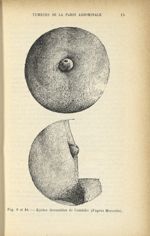 Fig. 9 et 10. Kystes dermoïdes de l'ombilic (d'après Morestin) - Atlas manuel de chirurgie des régio [...]