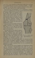 Fig. 5. - Fracture diaphyso-épiphysaire nécessitant l'amputation - Traitement des fractures. T. 1 :  [...]