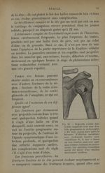 Fig. 10. - Projectile restant dans la tête humérale avec zone d'ostéite progressive - Traitement des [...]